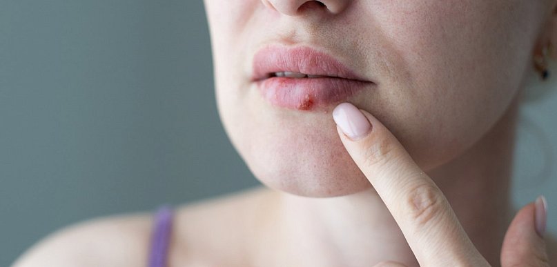 Czy można skutecznie zwalczyć opryszczkę?