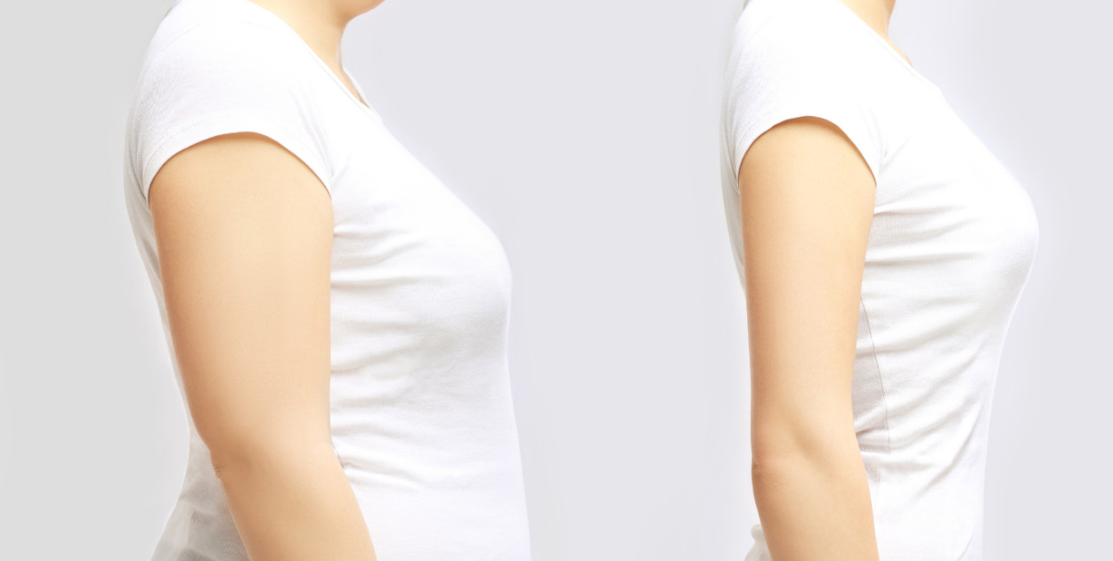 Liposukcja – kompletny przewodnik po metodzie modelowania sylwetki