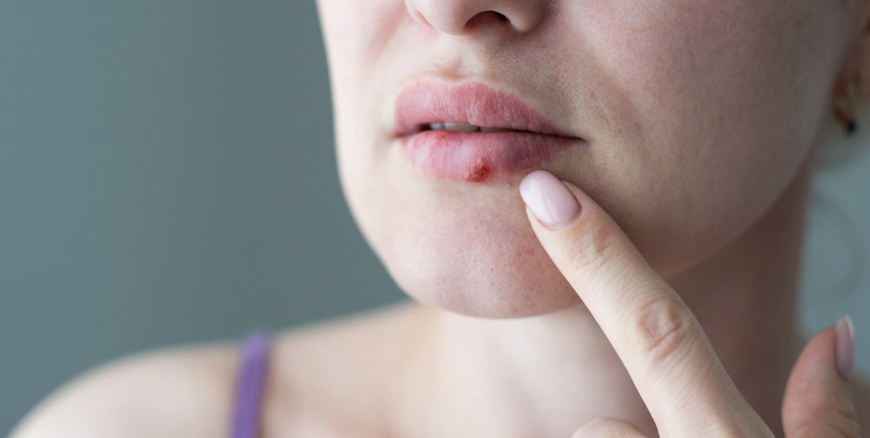 Czy można skutecznie zwalczyć opryszczkę?